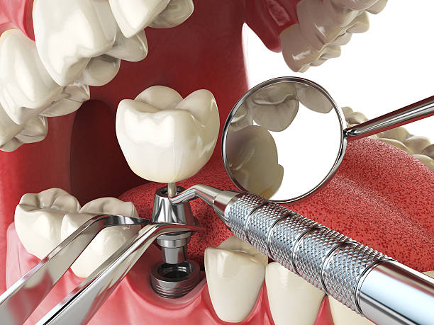 Best Emergency Tooth Extraction in Eagle Lake, FL